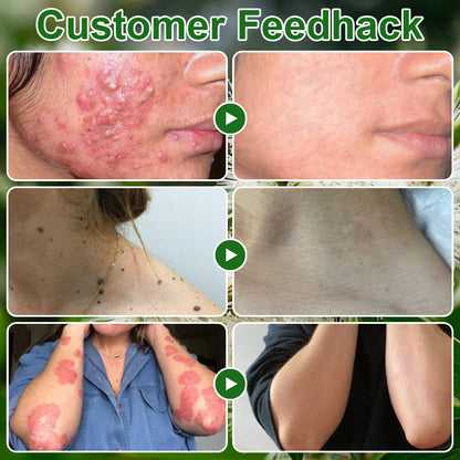 🔥𝐳𝐯𝐨𝐞𝐯𝐨® 𝐓𝐞𝐚 𝐓𝐫𝐞𝐞 𝐎𝐢𝐥 𝐒𝐤𝐢𝐧 𝐓𝐫𝐞𝐚𝐭𝐦𝐞𝐧𝐭 𝐂𝐫𝐞𝐚𝐦✅𝐅𝐃𝐀-𝐀𝐏𝐏𝐑𝐎𝐕𝐄𝐃 – Removes Skin Blemishes, Repairs Damaged Skin, Brightens & Anti-Ageing Care