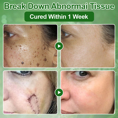 🔥𝐳𝐯𝐨𝐞𝐯𝐨® 𝐓𝐞𝐚 𝐓𝐫𝐞𝐞 𝐎𝐢𝐥 𝐒𝐤𝐢𝐧 𝐓𝐫𝐞𝐚𝐭𝐦𝐞𝐧𝐭 𝐂𝐫𝐞𝐚𝐦✅𝐅𝐃𝐀-𝐀𝐏𝐏𝐑𝐎𝐕𝐄𝐃 – Removes Skin Blemishes, Repairs Damaged Skin, Brightens & Anti-Ageing Care