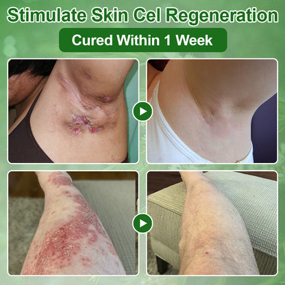 🔥𝐳𝐯𝐨𝐞𝐯𝐨® 𝐓𝐞𝐚 𝐓𝐫𝐞𝐞 𝐎𝐢𝐥 𝐒𝐤𝐢𝐧 𝐓𝐫𝐞𝐚𝐭𝐦𝐞𝐧𝐭 𝐂𝐫𝐞𝐚𝐦✅𝐅𝐃𝐀-𝐀𝐏𝐏𝐑𝐎𝐕𝐄𝐃 – Removes Skin Blemishes, Repairs Damaged Skin, Brightens & Anti-Ageing Care